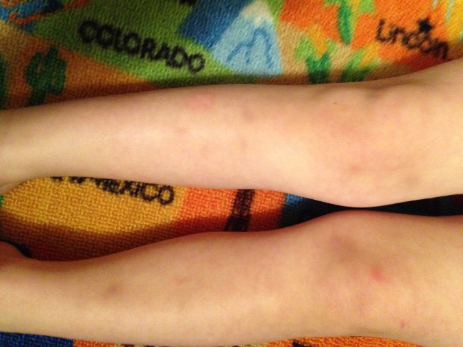 Bruised Little Knees